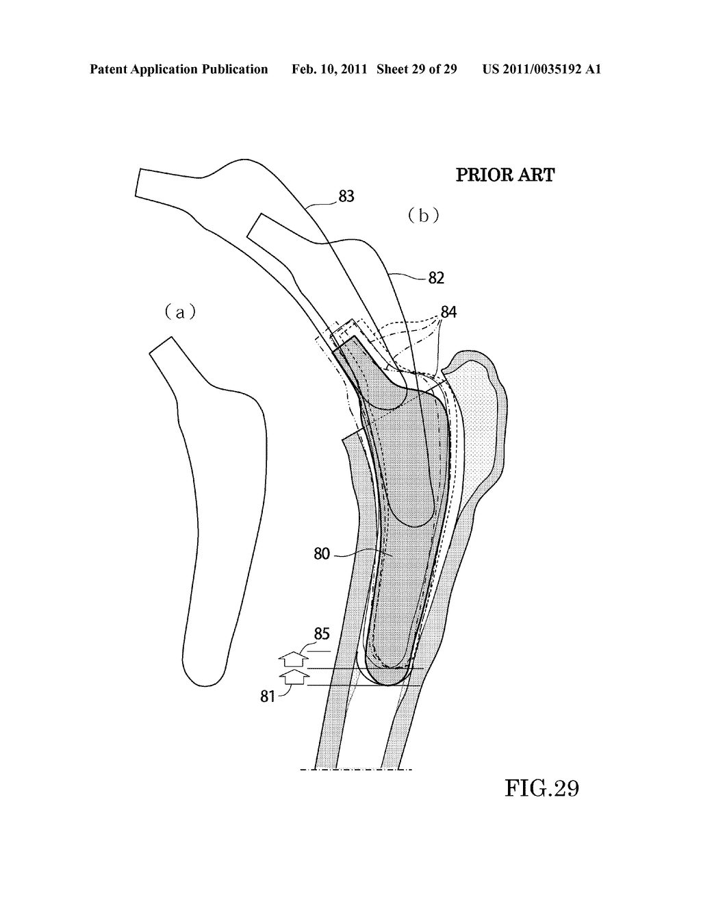 Method Of Determining Shape Of Artificial Cementless Hip Prosthesis Stem - diagram, schematic, and image 30