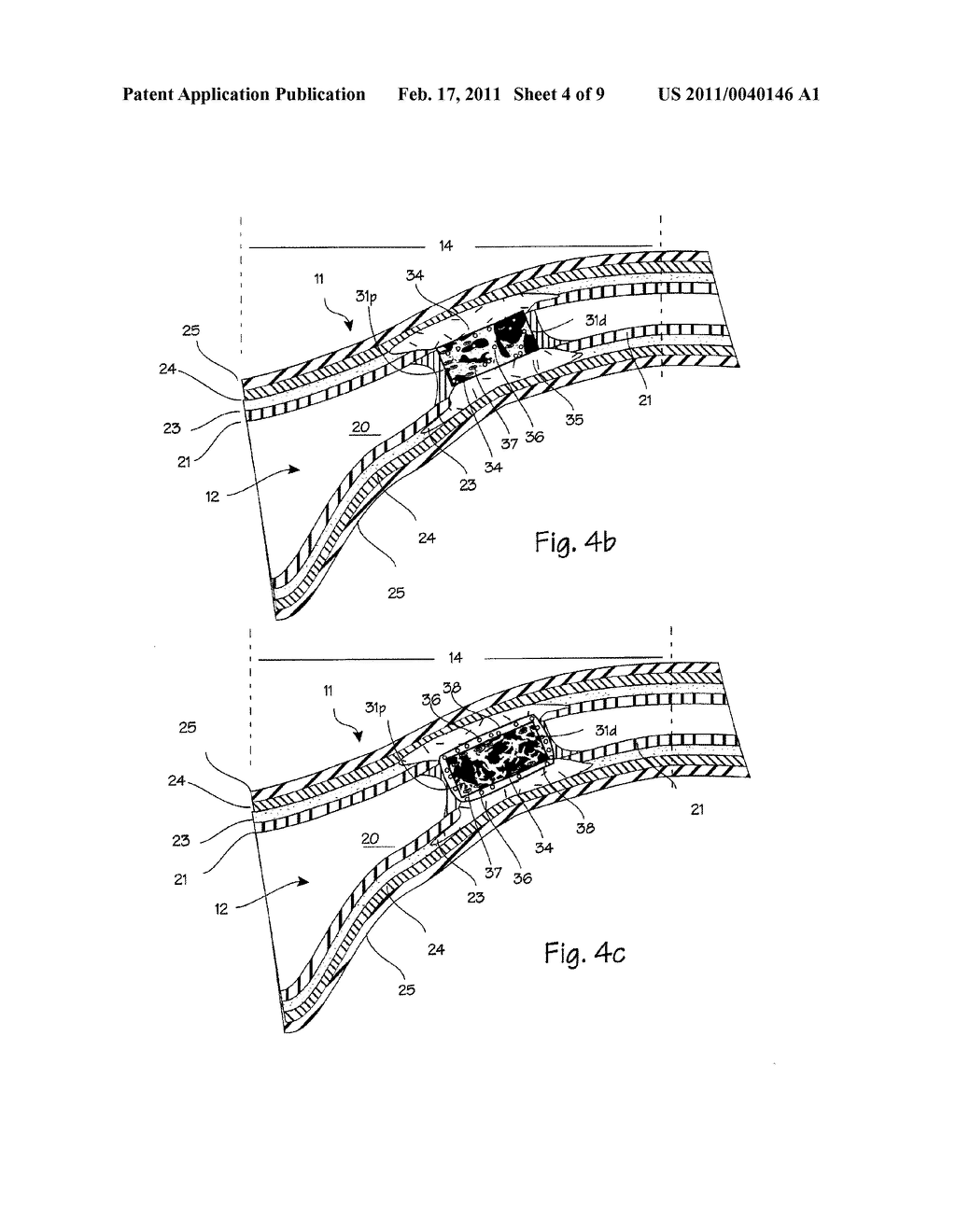 Method and Apparatus for Tubal Occlusion - diagram, schematic, and image 05