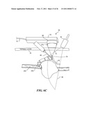 IMAGE GUIDED HIGH INTENSITY FOCUSED ULTRASOUND TREATMENT OF NERVES diagram and image