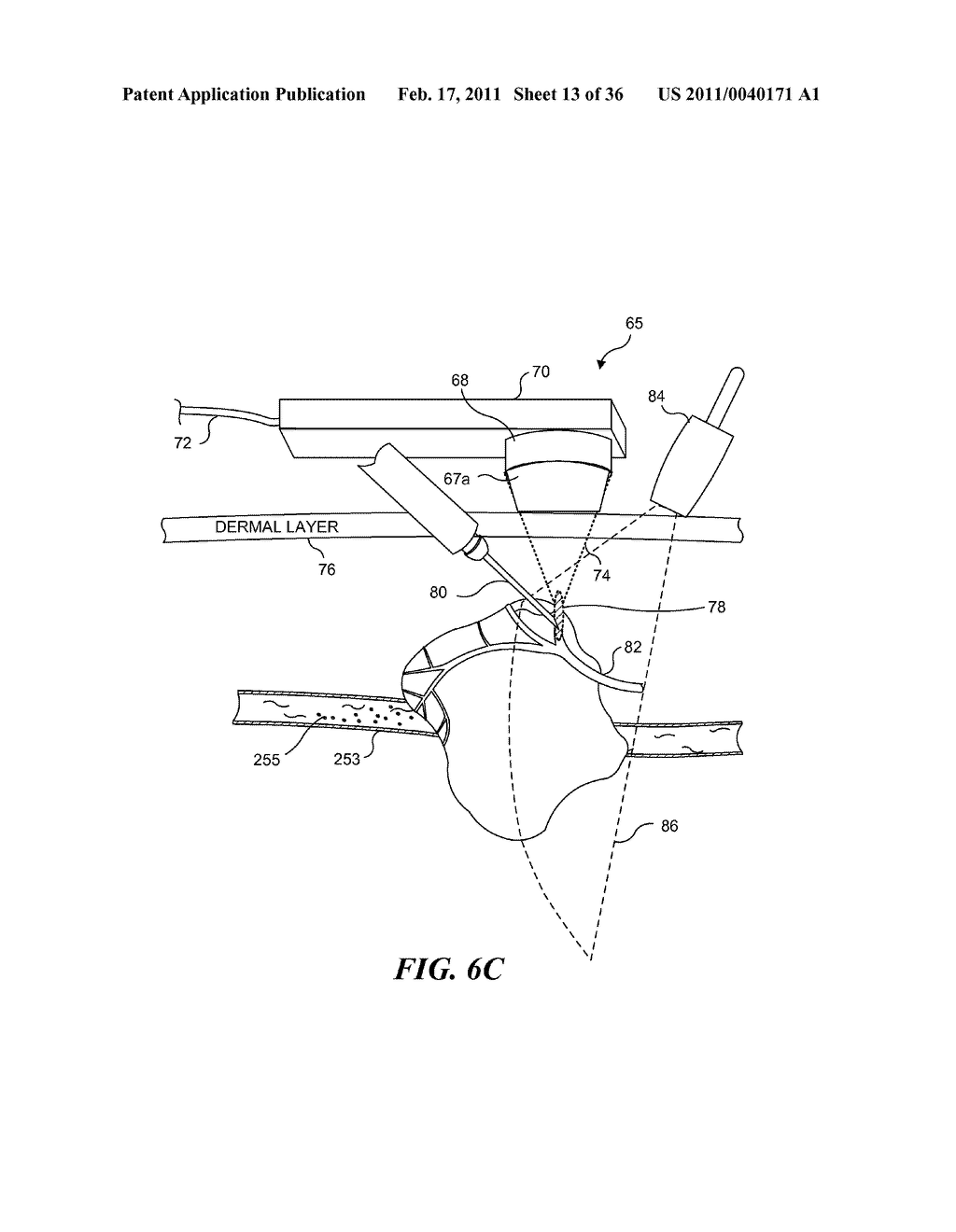 IMAGE GUIDED HIGH INTENSITY FOCUSED ULTRASOUND TREATMENT OF NERVES - diagram, schematic, and image 14