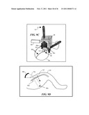 IMAGE GUIDED HIGH INTENSITY FOCUSED ULTRASOUND TREATMENT OF NERVES diagram and image