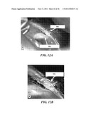 IMAGE GUIDED HIGH INTENSITY FOCUSED ULTRASOUND TREATMENT OF NERVES diagram and image