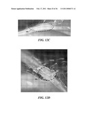 IMAGE GUIDED HIGH INTENSITY FOCUSED ULTRASOUND TREATMENT OF NERVES diagram and image