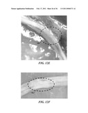 IMAGE GUIDED HIGH INTENSITY FOCUSED ULTRASOUND TREATMENT OF NERVES diagram and image