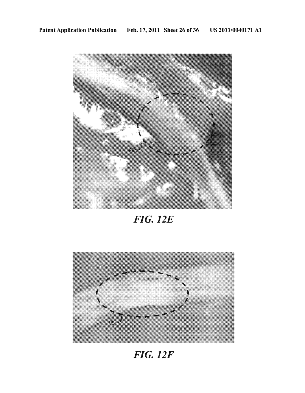 IMAGE GUIDED HIGH INTENSITY FOCUSED ULTRASOUND TREATMENT OF NERVES - diagram, schematic, and image 27