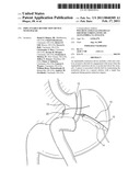 IMPLANTABLE RESTRICTION DEVICE WITH SPACER diagram and image