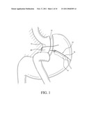 IMPLANTABLE RESTRICTION DEVICE WITH SPACER diagram and image