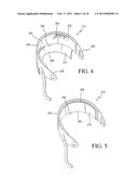 IMPLANTABLE RESTRICTION DEVICE WITH SPACER diagram and image