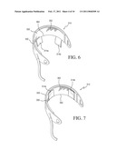 IMPLANTABLE RESTRICTION DEVICE WITH SPACER diagram and image