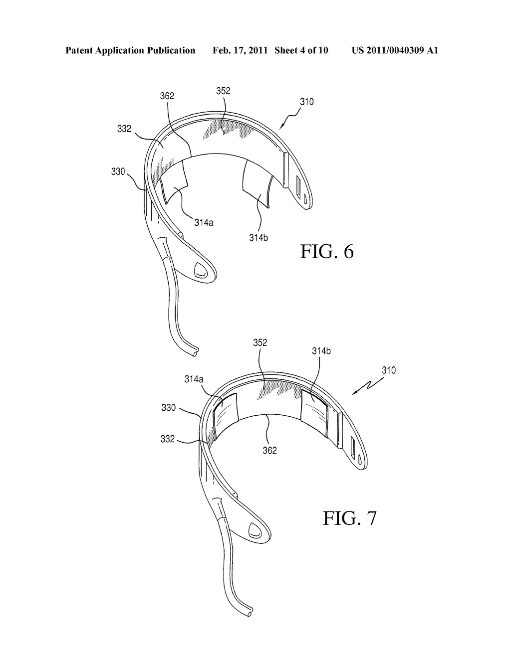 IMPLANTABLE RESTRICTION DEVICE WITH SPACER - diagram, schematic, and image 05