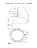 IMPLANTABLE RESTRICTION DEVICE WITH SPACER diagram and image