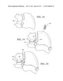 IMPLANTABLE RESTRICTION DEVICE WITH SPACER diagram and image