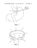 IMPLANTABLE RESTRICTION DEVICE WITH PROTECTIVE MEMBER diagram and image