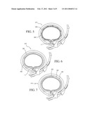 IMPLANTABLE RESTRICTION DEVICE WITH PROTECTIVE MEMBER diagram and image