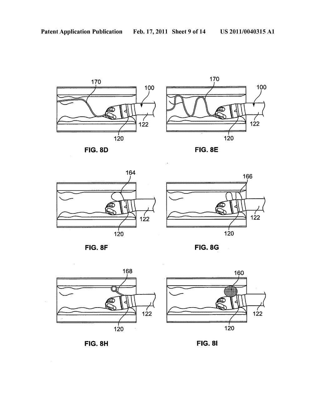 Devices, systems, and methods for cutting and removing occlusive material from a body lumen - diagram, schematic, and image 10