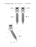 Thread-thru polyaxial pedicle screw system diagram and image