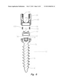 Thread-thru polyaxial pedicle screw system diagram and image