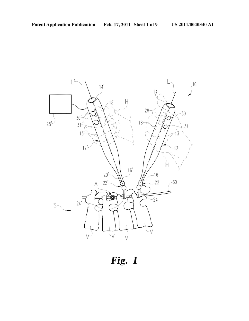 Instruments and Methods for In Situ Bending of an Elongate Spinal Implant - diagram, schematic, and image 02