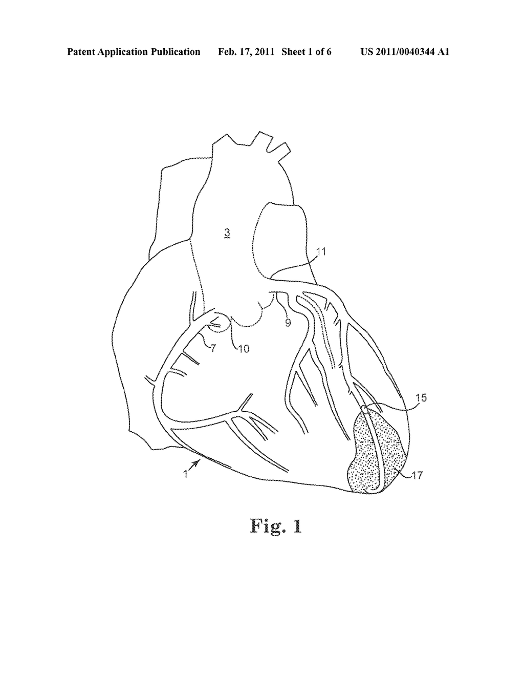 MYOCARDIAL INFARCTION TREATMENT SYSTEM WITH ELECTRONIC REPOSITIONING - diagram, schematic, and image 02