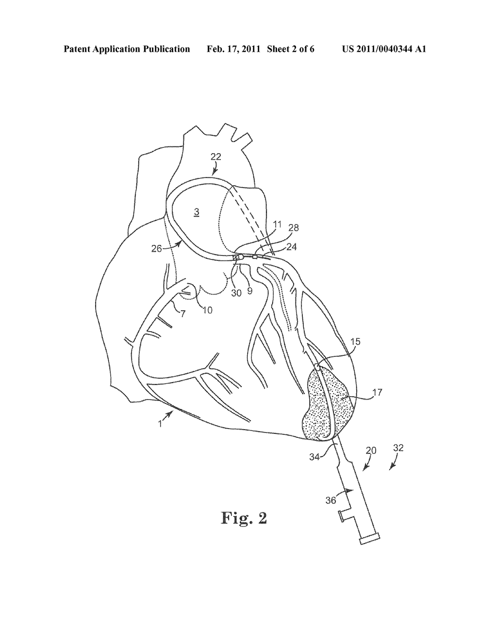 MYOCARDIAL INFARCTION TREATMENT SYSTEM WITH ELECTRONIC REPOSITIONING - diagram, schematic, and image 03