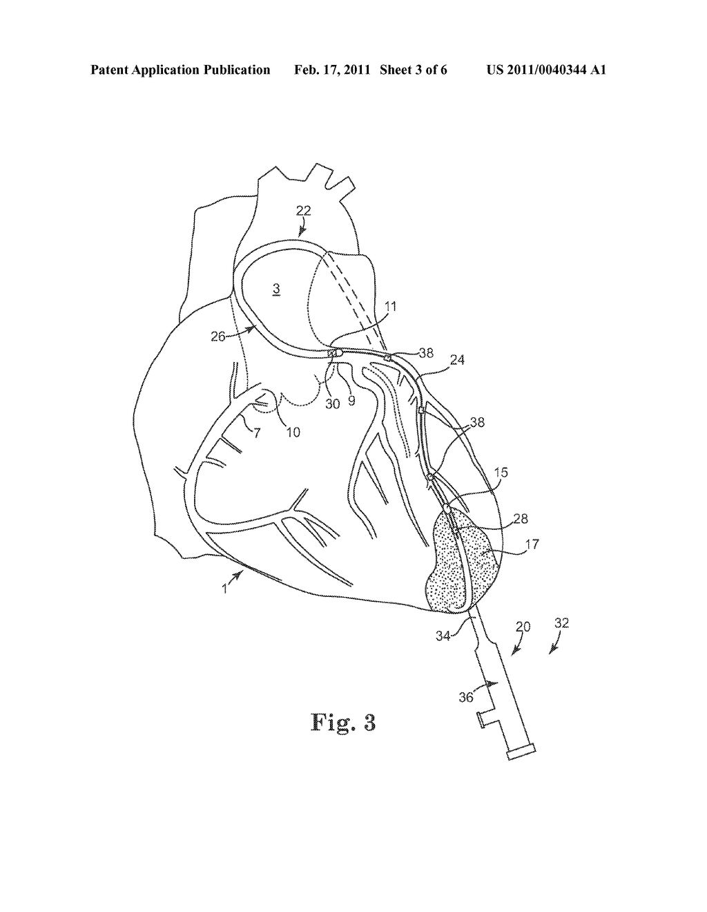 MYOCARDIAL INFARCTION TREATMENT SYSTEM WITH ELECTRONIC REPOSITIONING - diagram, schematic, and image 04