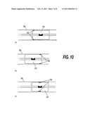 CATHETER diagram and image