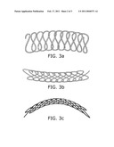 COILED ASSEMBLY FOR SUPPORTING THE WALL OF A LUMEN diagram and image