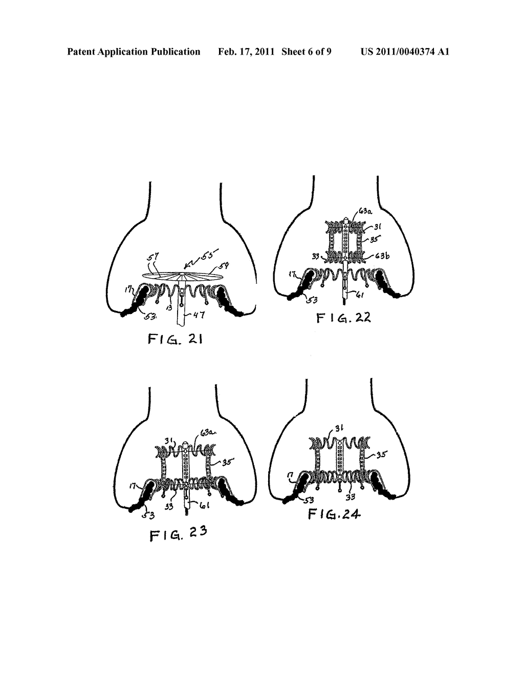 MINIMALLY INVASIVE HEART VALVE REPLACEMENT - diagram, schematic, and image 07