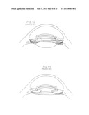 INTRAOCULAR LENS SYSTEM diagram and image