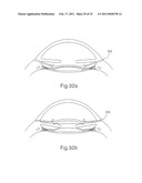 INTRAOCULAR LENS SYSTEM diagram and image