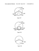 Multifocal Lens Having A Progressive Optical Power Region and a Discontinuity diagram and image