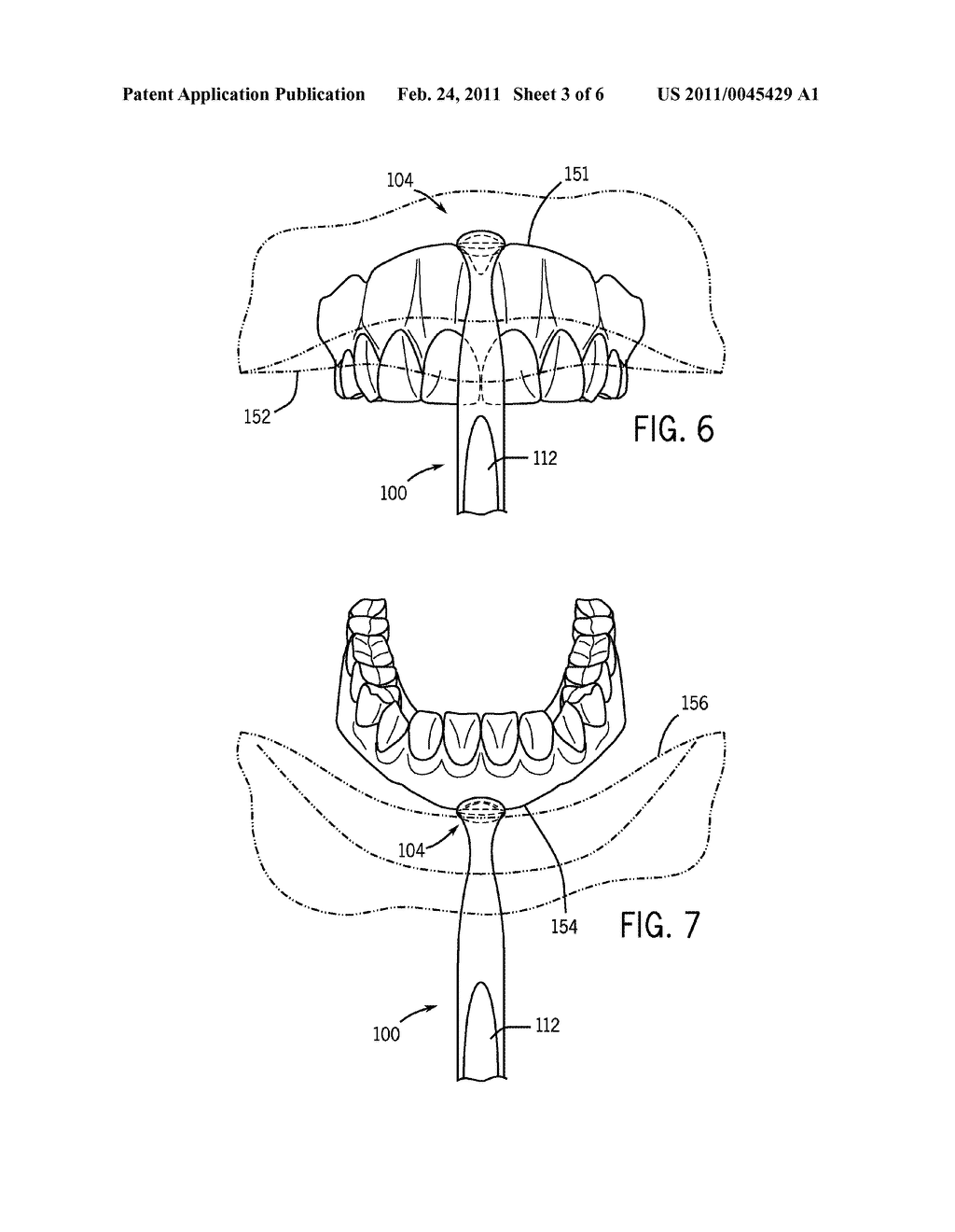 Dental Prosthesis Removal Tool - diagram, schematic, and image 04