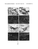 UPREGULATION OF RACK-1 IN MELANOMA AND ITS USE AS A MARKER diagram and image