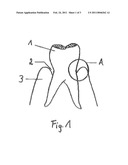 Pasty Insert Material for Widening of Gingival Sulcus and Use Thereof diagram and image