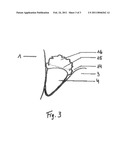 Pasty Insert Material for Widening of Gingival Sulcus and Use Thereof diagram and image