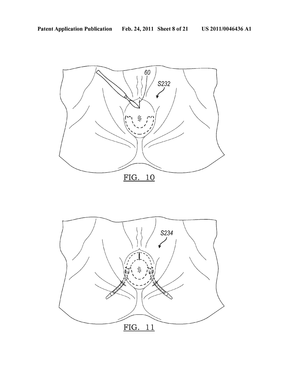 ANAL SLING SYSTEM AND METHOD TO TREAT FECAL INCONTINENCE - diagram, schematic, and image 09