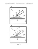 Vascular access methods and devices diagram and image