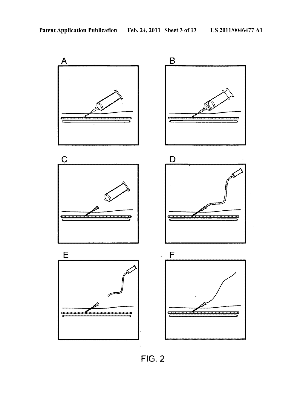 Vascular access methods and devices - diagram, schematic, and image 04