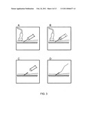 Vascular access methods and devices diagram and image