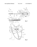 DEVICE FOR MEASURING THE SIZE OF AN INTRACARDIAC OPENING diagram and image