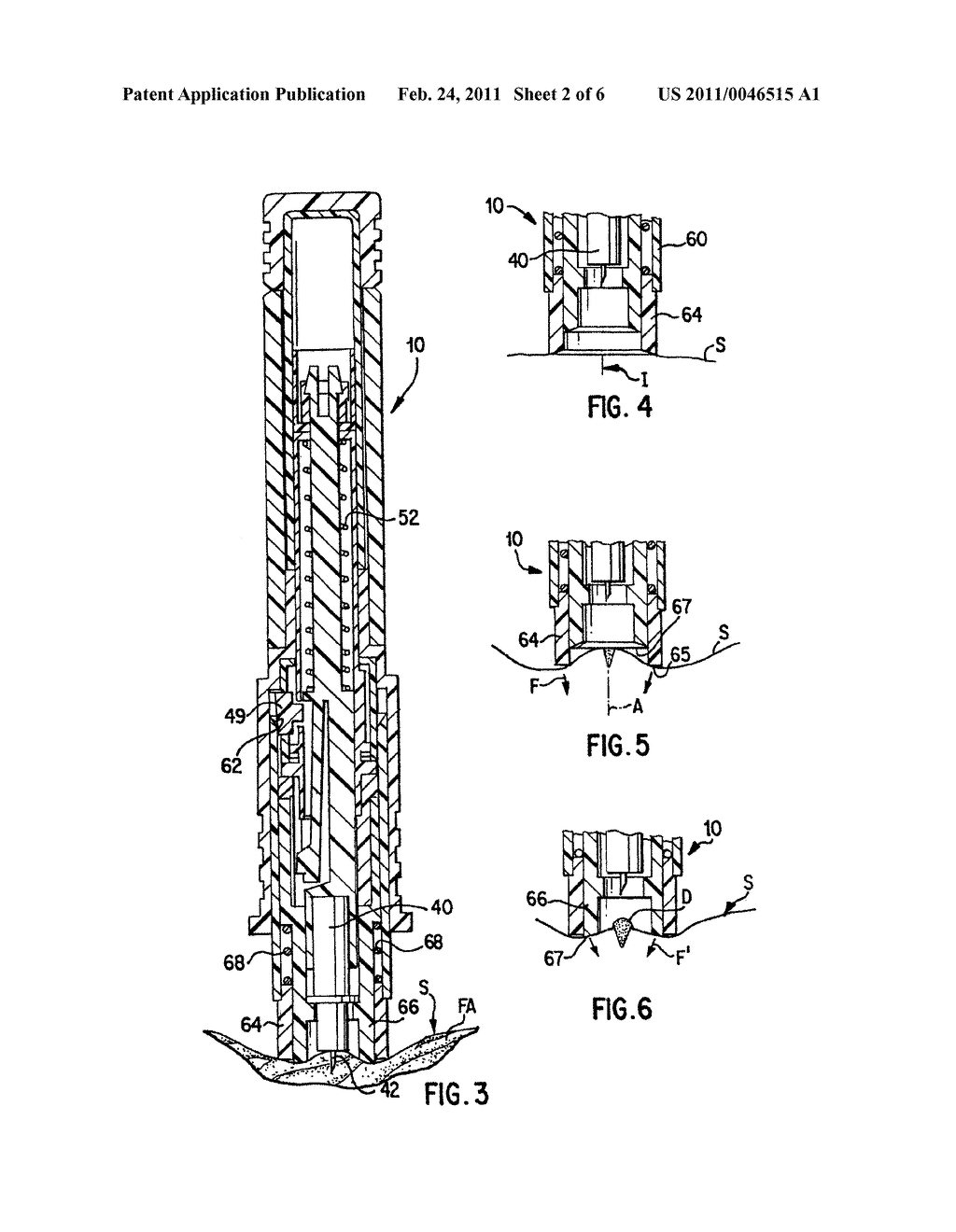 METHODS AND APPARATUS FOR EXPRESSING BODY FLUID FROM AN INCISION - diagram, schematic, and image 03