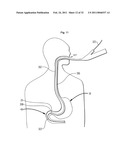 Systems and Methods for Treatment of Obesity and Type 2 Diabetes diagram and image