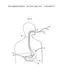 Systems and Methods for Treatment of Obesity and Type 2 Diabetes diagram and image