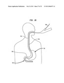 Systems and Methods for Treatment of Obesity and Type 2 Diabetes diagram and image