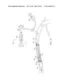 APPARATUS AND METHODS FOR CLOT DISSOLUTION diagram and image