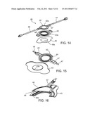 LIQUID STREAMING DEVICES AND METHOD OF USING SUCH DEVICES FOR TREATING WOUNDS diagram and image