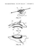 LIQUID STREAMING DEVICES AND METHOD OF USING SUCH DEVICES FOR TREATING WOUNDS diagram and image