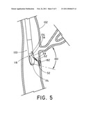 Echogenic Electrosurgical Device diagram and image