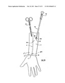 Instruments and Methods for Minimally Invasive Carpal Tunnel Release diagram and image