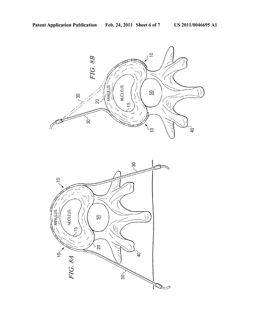 SYSTEM AND METHOD FOR ELECTRICAL STIMULATION OF THE INTERVERTEBRAL DISC - diagram, schematic, and image 07